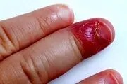 والدین در برابر ناخن جویدن کودکانشان چه کنند؟