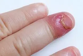 والدین در برابر ناخن جویدن کودکانشان چه کنند؟