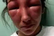 بلای وحشتناکی که بوتاکس قلابی بر سر چهره این زن آورد+ عکس