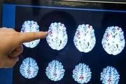 علت اصلی بیماری آلزایمر کشف شد 