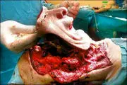 جراحی ترسناک، صورت یک نفر را به چهره این مرد پیوند زدند/ عکس