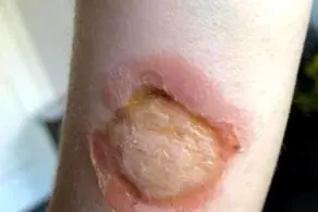 بلای دردناکی که این حشره بر سر دختربچه آورد! + عکس