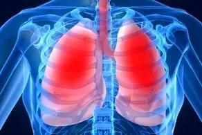 از سوراخ شدن ریه تا تخریب پارانشیم ریوی، عوارض افزایش یافته  کرونایی!