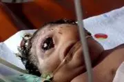 تولد نوزاد وحشتناک فقط با یک چشم!/تصاویر 18+