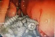 خروج ۴۷ پیچ از معده یک بیمار در کرج بدون جراحی!