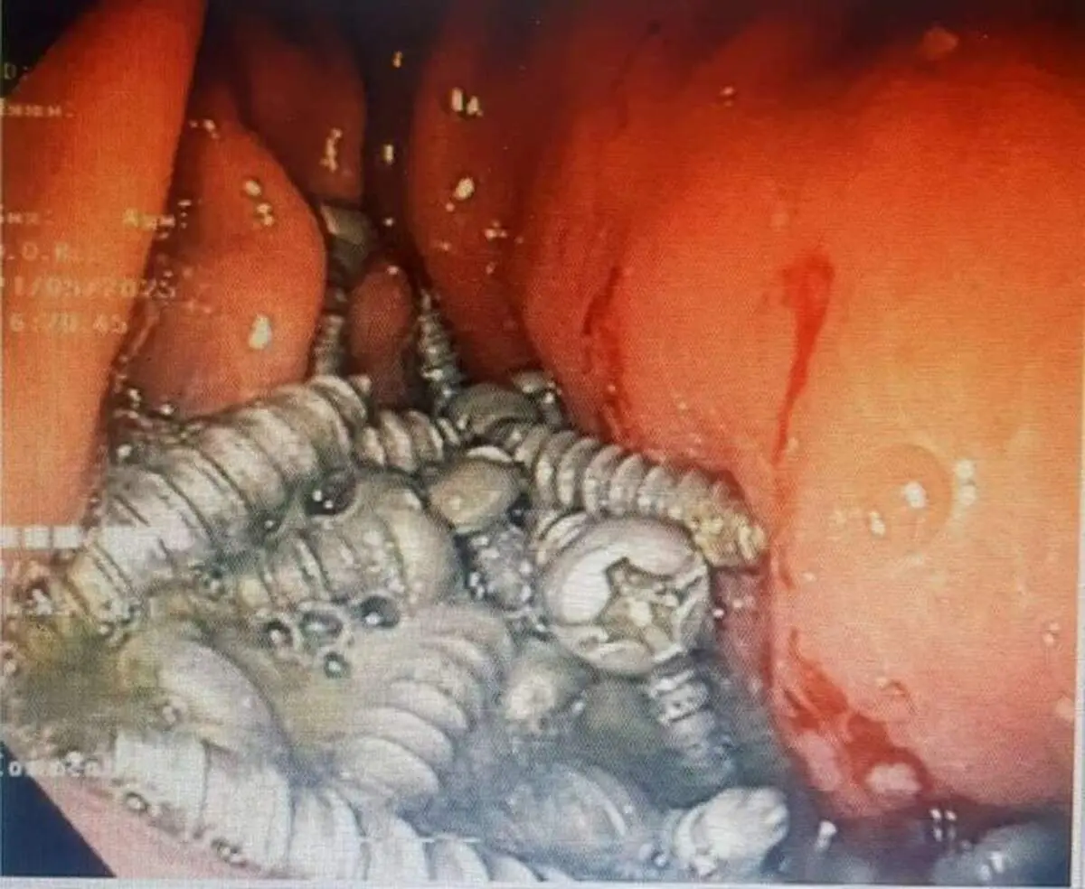 خروج ۴۷ پیچ از معده یک بیمار در کرج بدون جراحی!
