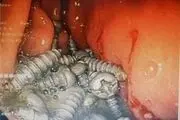 خروج ۴۷ پیچ از معده یک بیمار در کرج بدون جراحی!