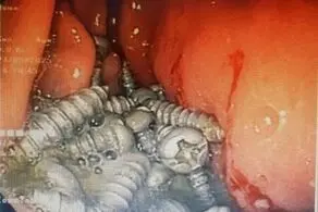 خروج ۴۷ پیچ از معده یک بیمار در کرج بدون جراحی!