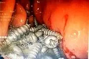 خروج ۴۷ پیچ از معده یک بیمار در کرج بدون جراحی!