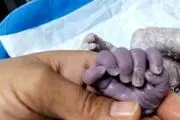 تولد نوزاد ۲۴ انگشتی با رنگ پوست بنفش!+عکس