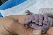 تولد نوزاد ۲۴ انگشتی با رنگ پوست بنفش!+عکس