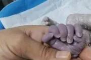 تولد نوزاد ۲۴ انگشتی با رنگ پوست بنفش!+عکس