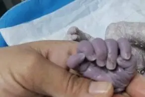 تولد نوزاد ۲۴ انگشتی با رنگ پوست بنفش!+عکس