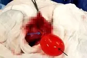 پیدا شون یک بادکنک پر از آب در شکم پسر جوان/هیچکس نمیدانست از کجا آمده!+عکس