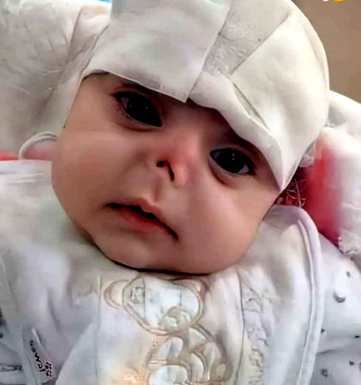 موش دماغ این نوزاد زیبا را خوردند!+عکس دلخراش